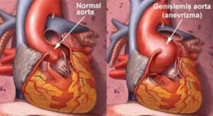 Aort Yırtılması Nedir? Belirtileri, Nedenleri ve Tedavi Yöntemleri