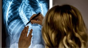 Skolyoz Nedir? Belirtileri ve Tedavileri Nelerdir?