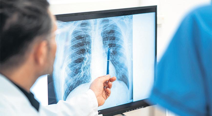 Sigara İçmeyenlerde Akciğer Kanseri Artışının Nedenleri ve Güncel Bilgiler