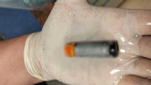 Denizli’de doktorları şaşkına çeviren olay! 39 yaşındaki bir kişi pil yuttu