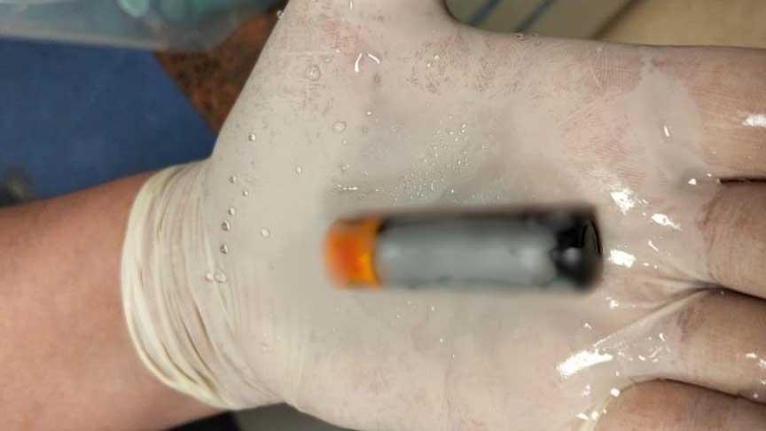 Denizli’de doktorları şaşkına çeviren olay! 39 yaşındaki bir kişi pil yuttu