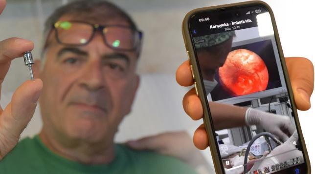 Diş İmplantından Kaçan Yabancı Cisim: Akciğerde Tehlikeli Bir Yolculuk ve Hızlı Müdahale