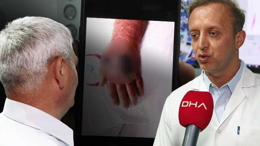 Elini ısıran hırsız yüzünden kolu kesilecekti! Doktorlar şaşkın: Bizim için de ilk oldu, literatüre girecek