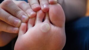 Nasır deyip geçmeyin, ciddiye alın! Ayak sağlığını tehdit ediyor