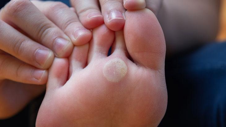Nasır deyip geçmeyin, ciddiye alın! Ayak sağlığını tehdit ediyor