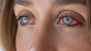 Alerjik Konjonktivit ve Göz Sağlığı: Belirtiler, Riskler ve Korunma Yöntemleri