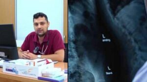 Bronkoskopiyle Akciğerden Çıkarılan Kabak Çekirdeğiyle Gelen Şifa: Aysel Türkeş’in Öyküsü