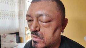 Ferdiyedeki Berberin Tavsiyesiyle Satın Alınan Şampuan Sonrası Yaşanan Alerjik Reaksiyon ve Hukuki Adımlar