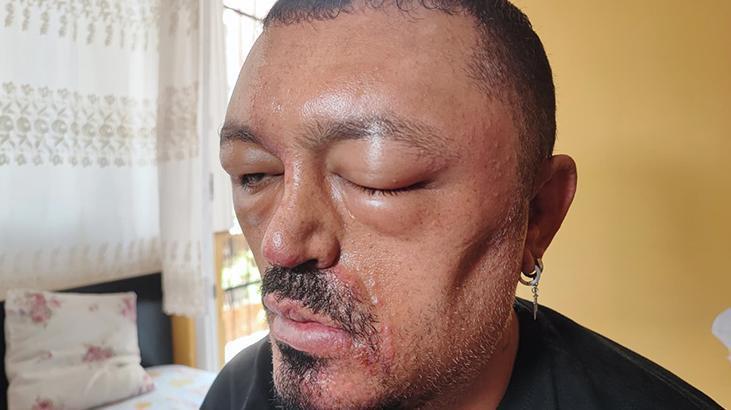 Ferdiyedeki Berberin Tavsiyesiyle Satın Alınan Şampuan Sonrası Yaşanan Alerjik Reaksiyon ve Hukuki Adımlar