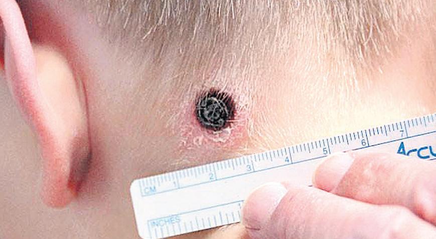 Tularemi Vakaları ve Kamu Sağlığı: Artışın Nedenleri ve Önlemler