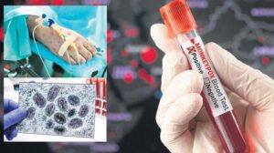 Türkiye’de Mpox Vakası İddiaları ve DSÖ Verileri Üzerine Güncel Değerlendirme