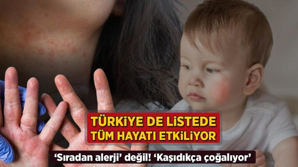 Atopik Dermatit: Genetik ve Çevresel Etkenlerin Etkileşimiyle Yükselen Kronik Cilt Hastalığına Yaklaşım