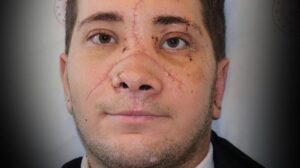 Burun Rekonstrüksiyonuyla Yaşama Tutunan Genç: Kaza Sonrası Bir Başarı Hikayesi