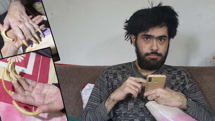 Deprem Sonrası Hayata Döndürülmeye Çalışılan Genç: 3 Yıldır Evden Çıkmayan Barış ve Ailesinin İçten Mücadele Hikayesi