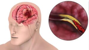 Inme: Acil Müdahale, Erken Rehabilitasyon ve Teknolojideki Gelişmeler