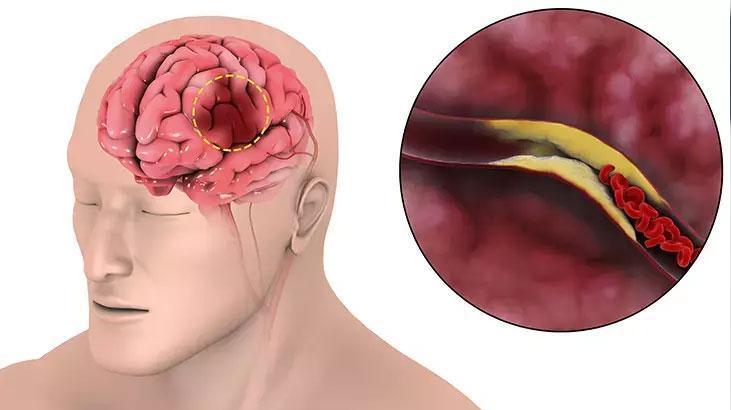 Inme: Acil Müdahale, Erken Rehabilitasyon ve Teknolojideki Gelişmeler