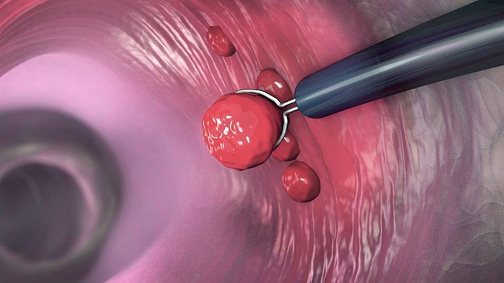 Kolon Polipleri ve Sağlıklı Yaşam: Erken Tanı ve Korunma Stratejileri