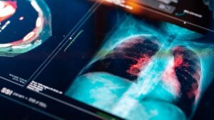 Akciğer Kanseri: Küresel Eğilimler, Risk Faktörleri ve Erken Teşhisin Önemi