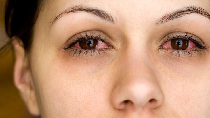 Kış Aylarında Göz Sağlığı: Kuruluk ve Konjonktivitte Dikkat Edilmesi Gerekenler