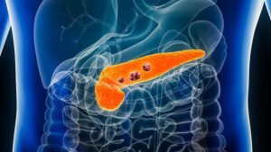 Pankreas Kanseri Farkındalık Ayı: Umutla Sürülen Tedavi Yolculuğu ve Güncel Başarılar