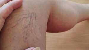 Sonbahar ve Kışta Varis Tedavisi: Dönemin Avantajları ve Pratik Önlemler