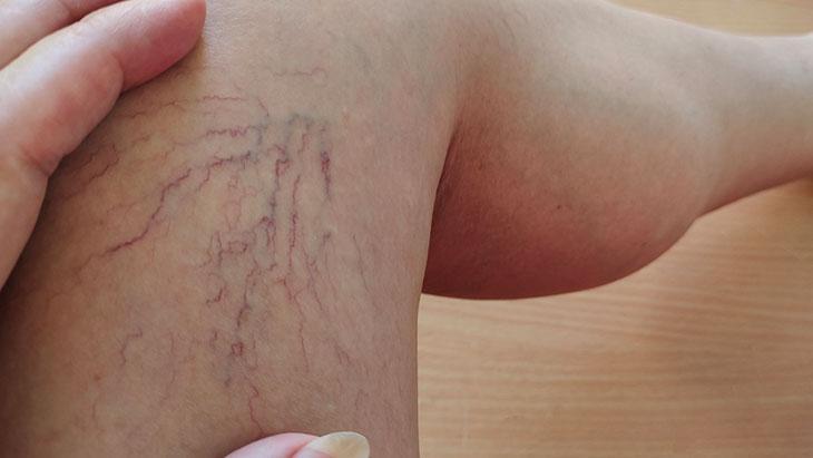 Sonbahar ve Kışta Varis Tedavisi: Dönemin Avantajları ve Pratik Önlemler