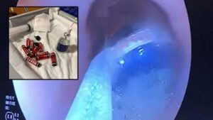 Ağrı’da Mahpusun Midesinde Çok Sayıda Yabancı Cisim: Endoskopik Müdahale ile 9 Pil Çıkarıldı