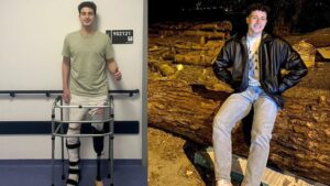 Amputasyona Yol Açan Kaza Sonrası Berk Civil’in Fizik Tedavi Yolculuğu