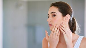 BBL Lazer ile Akne ve İzlerinde Güçlü ve Konforlu Tedavi Yaklaşımı