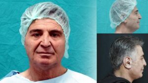 Derin Plan Yüz Germe ile Doğal ve Gençleşen Görünüm: Bitlis’te İlk Deneyim