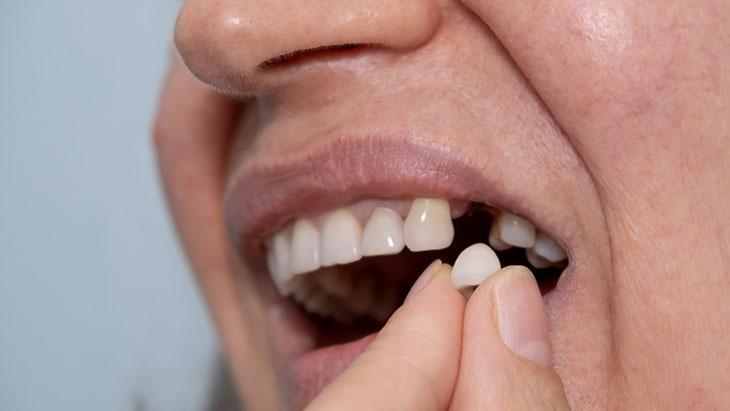 Diş Kaybının Geniş Yararları ve Korunma Stratejileri