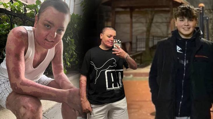 Hamidiye Mahallesi’nde Çaydanlık Yangını ve Buzdolabına Sıçrayan Alevler: Genç Yaralı Olayın Ayrıntıları