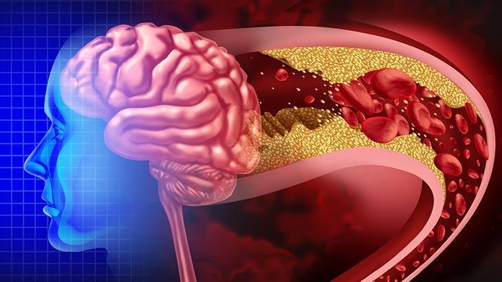 İnme Bilincini Artıran Sempozyum: Mucize Organ Bey ve Yaşamı Değiştiren Hikayeler