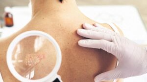 Küresel Sedef Pdp: Yüksek Gelirli Bölgelerde Artış mı Yoksa Tanı Farklı mı?