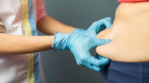 Lipödem: Hormonal Düzen ve Lenfatik Durgunlukla Sürdürülen Zorluklar