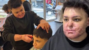 Yangında Ağır Yaralanan Çocuk İçin Gelişen Hikaye ve Tedavi Süreci