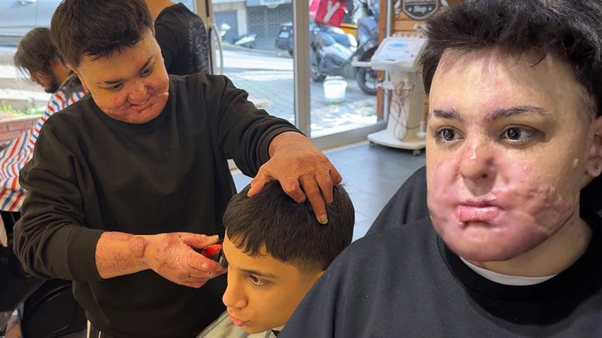 Yangında Ağır Yaralanan Çocuk İçin Gelişen Hikaye ve Tedavi Süreci