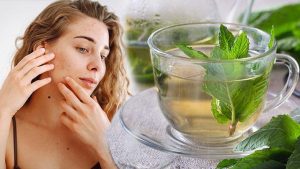 Hormonal Akne ve Doğal Yaklaşımlar: Dengeli Bir Tedavi İçin Bilimsel Perspektif