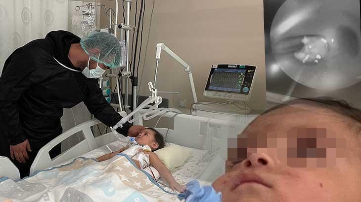 Ceviz Faciasını Önleyen ECMO ile Hayata Dönüş: Cabir Ata Kıran’ın Öyküsü